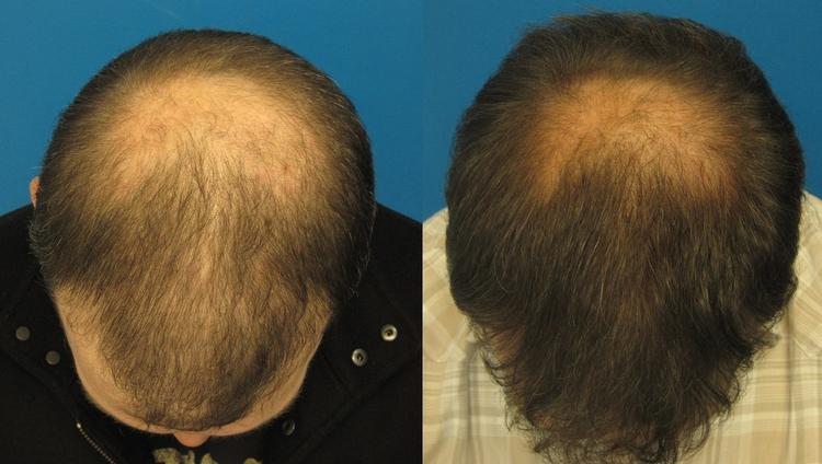 Лосьон-активатор роста волос Pelo Baum на 1 месяц. Средство от облысения и для роста волос.
